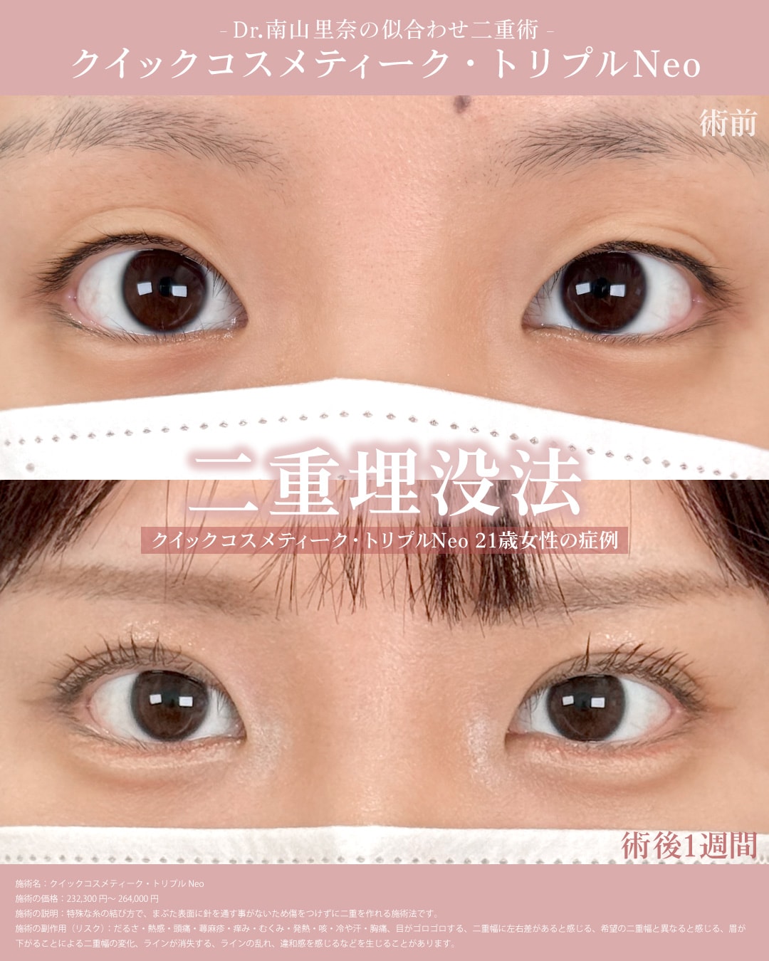 二重テープを卒業して自然な末広二重になりたい