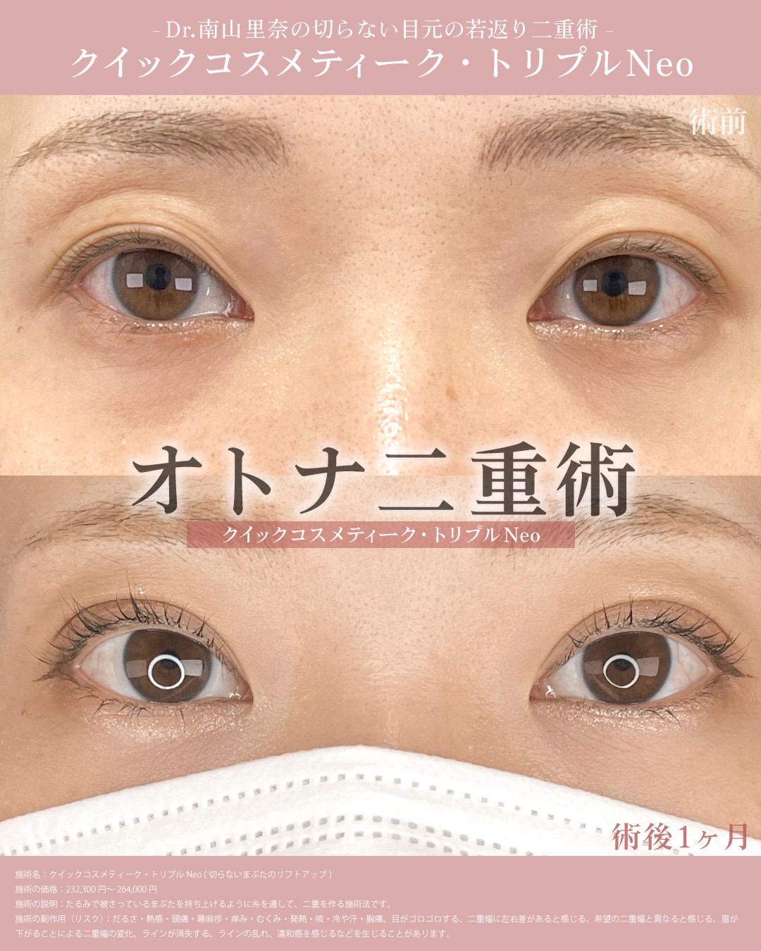 【切らないまぶたのリフトアップ】症例①