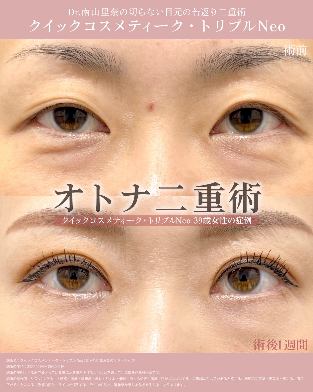 【切らないまぶたのリフトアップ】症例②