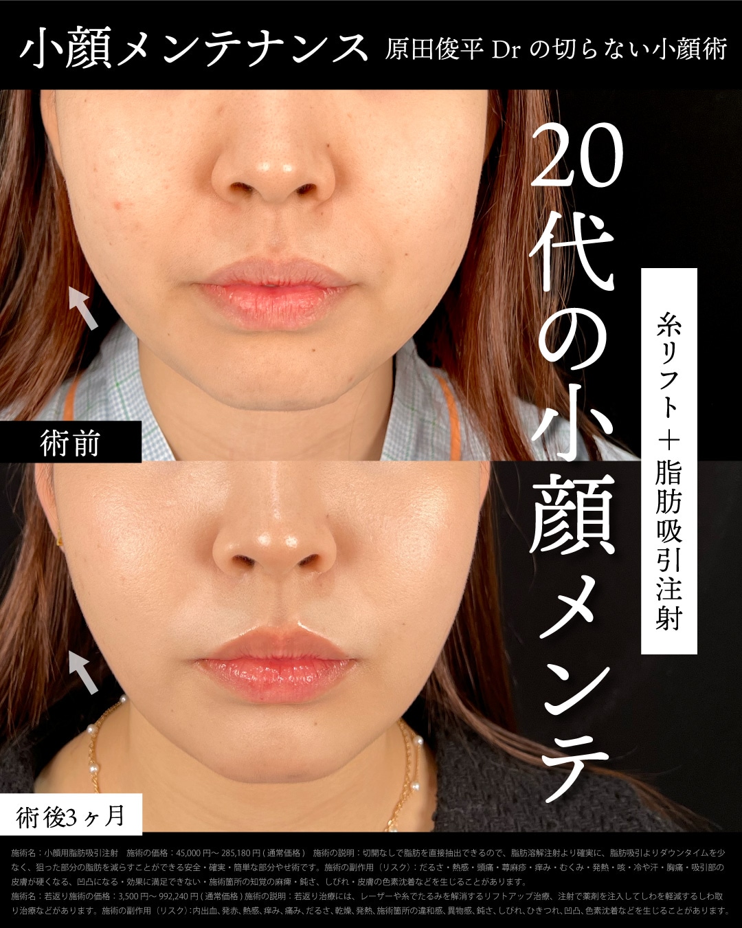 脂肪吸引注射(ほほ)＋プリマリフト4本