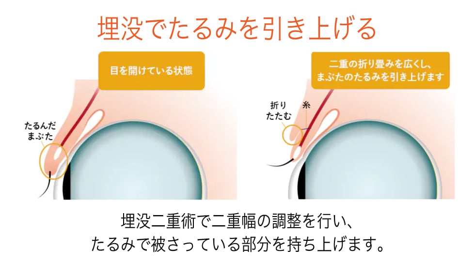 切らないまぶたのリフトアップとは