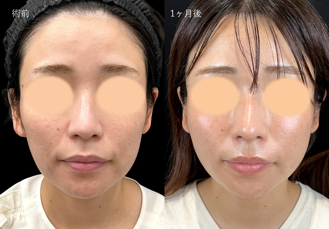 シークレットリフト12本＋ヒアルロン酸（ほほ＋ほうれい線）