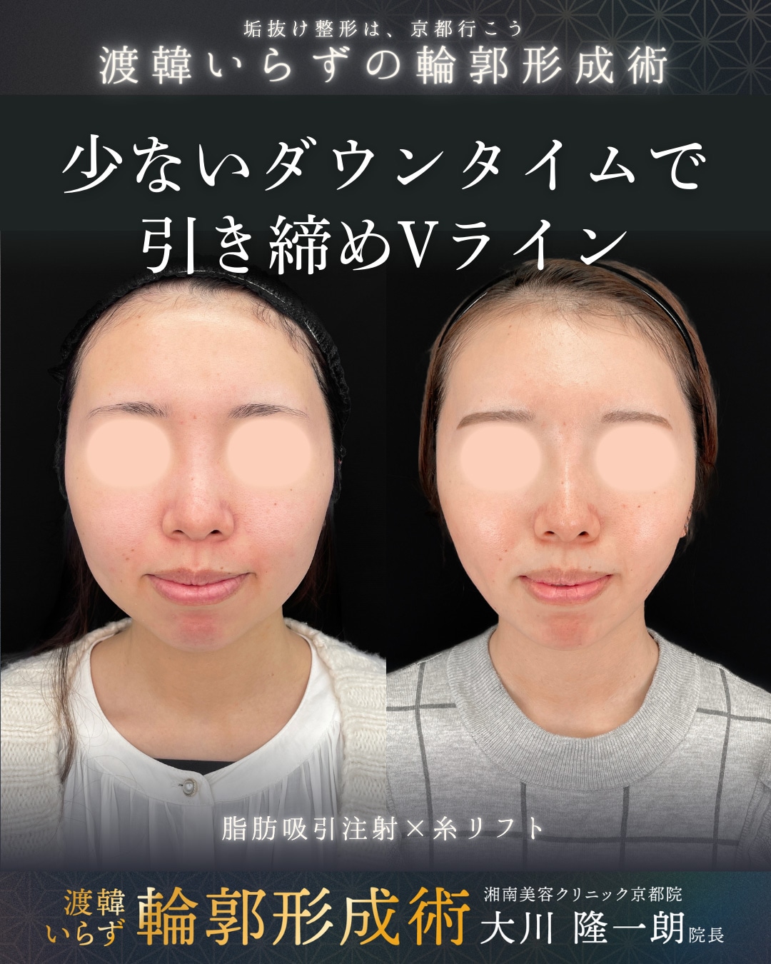 脂肪吸引注射(ほほ)＋プリマリフト6本