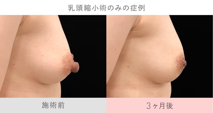乳頭縮小術 症例写真