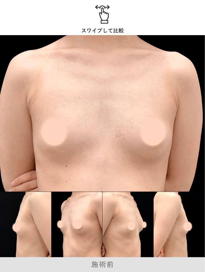 京都院 大川院長による脂肪注入豊胸 術前