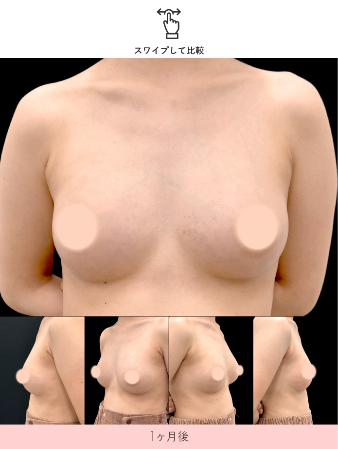 京都院 脂肪注入豊胸 お椀型バスト症例 1ヶ月後