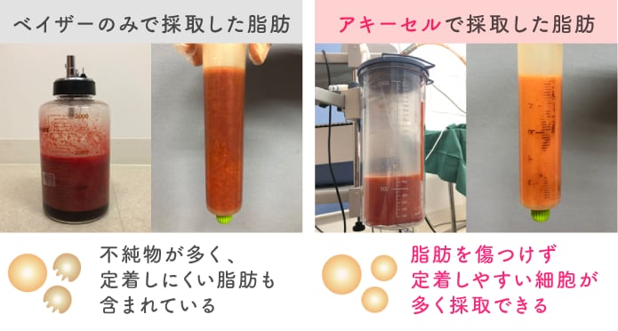 細胞を壊さない！アキーセル脂肪吸引