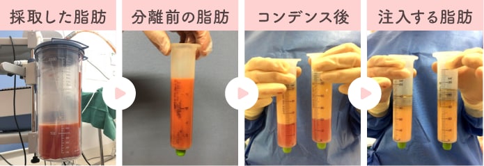 不純物を除去！コンデンスリッチ脂肪注入