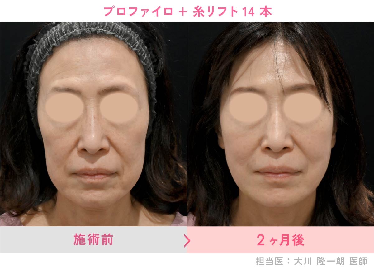 京都院におけるスキンブースターの症例実績