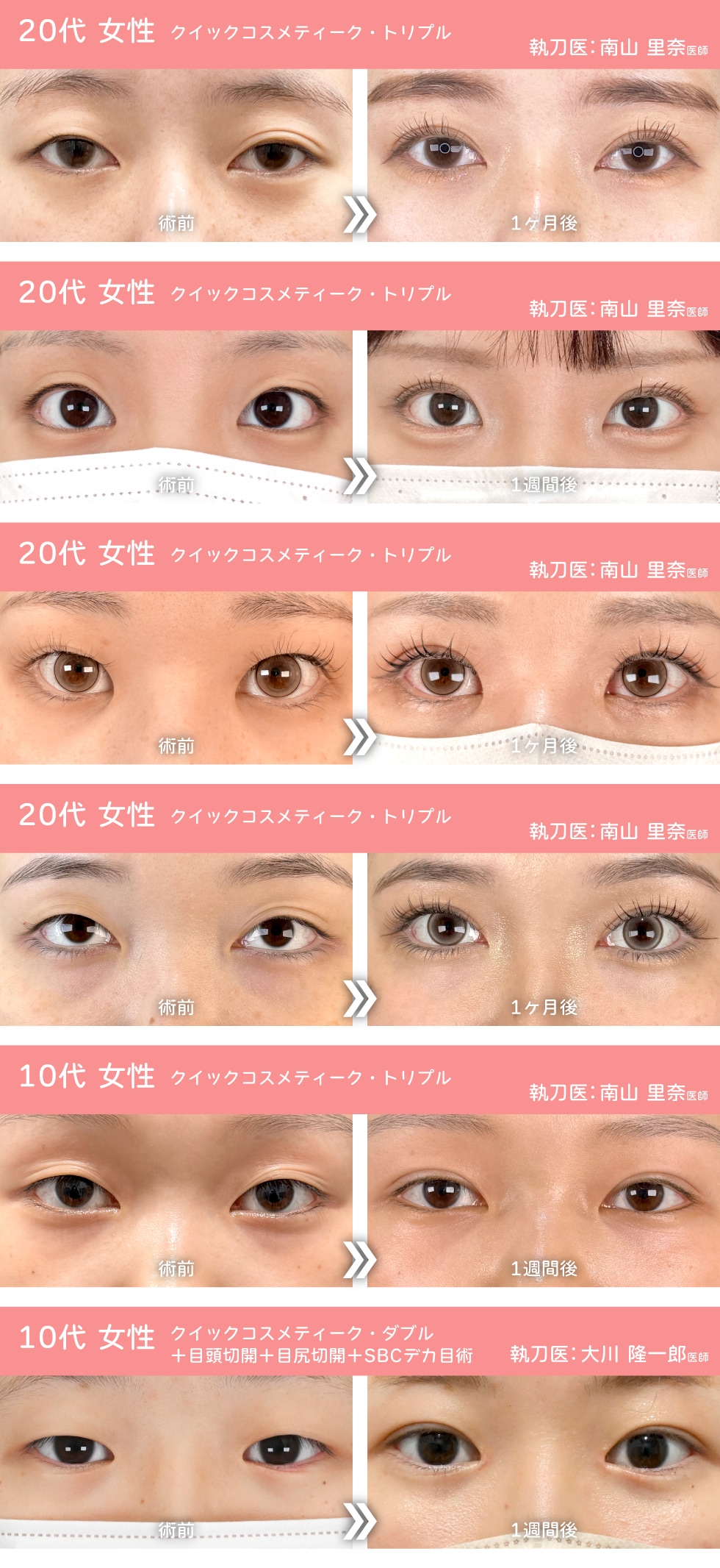 二重整形でここまで印象が変わる！