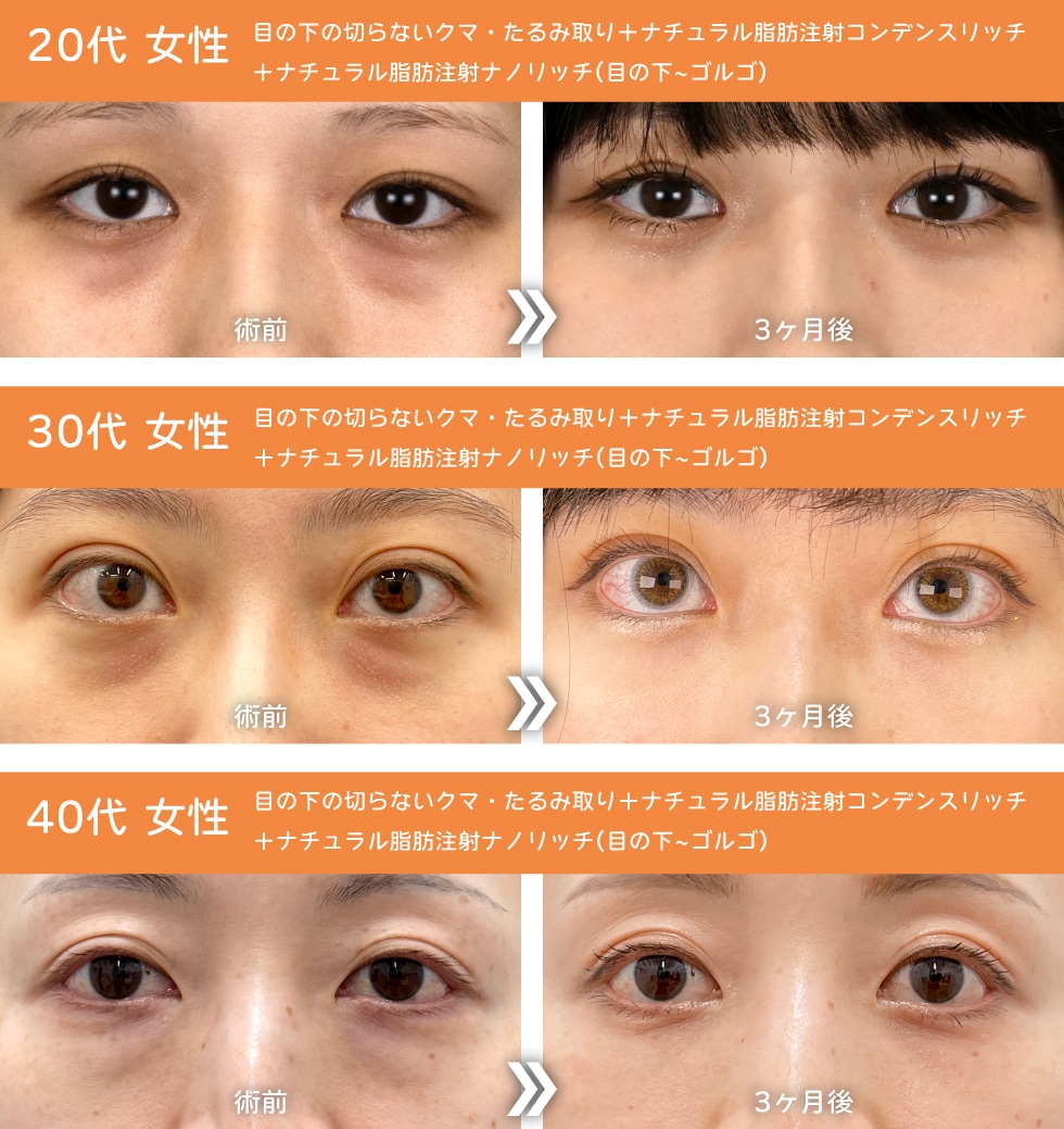 クマ取りで【垢抜け感】と【透明感】をプラス♡