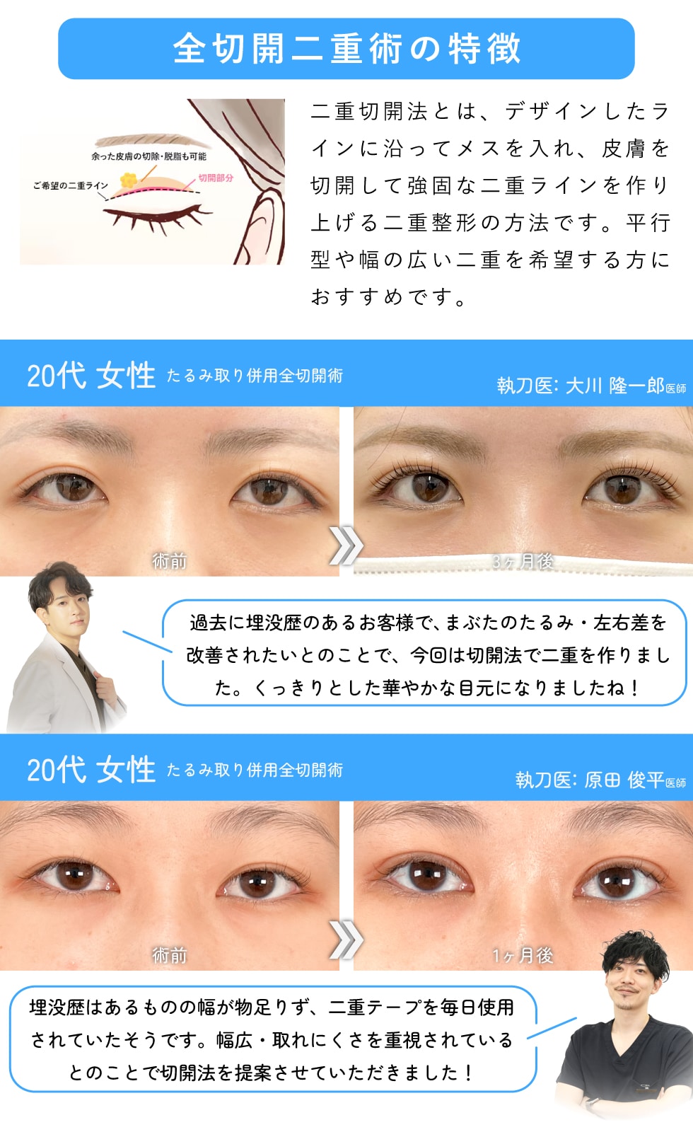 まぶたが厚く埋没法が難しい方に【全切開二重術】