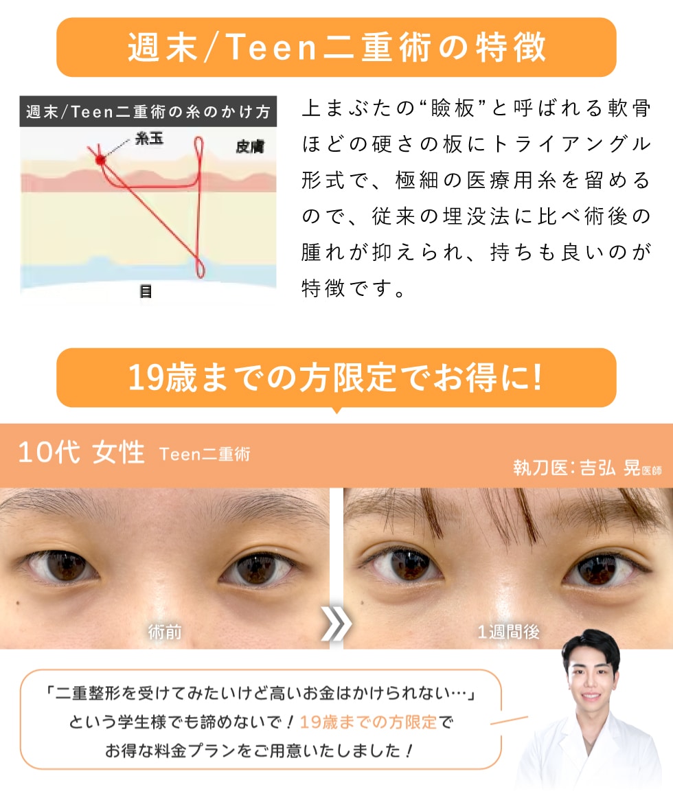 なるべく価格を抑えて二重になりたい方に【週末/Teen二重術】
