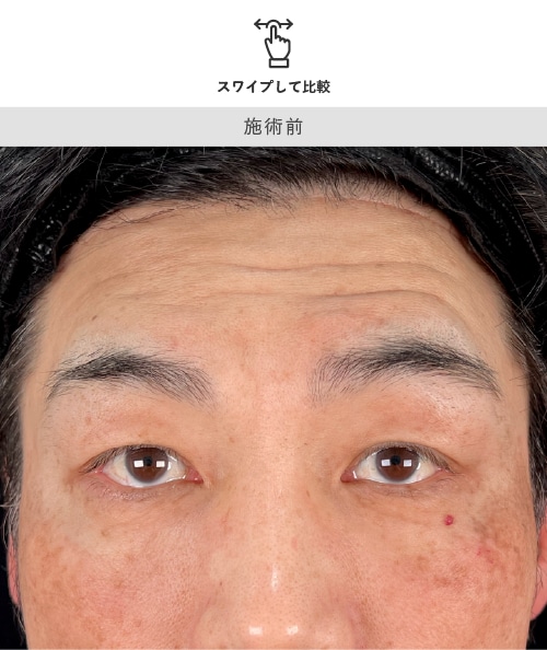 眉下リフト 術前