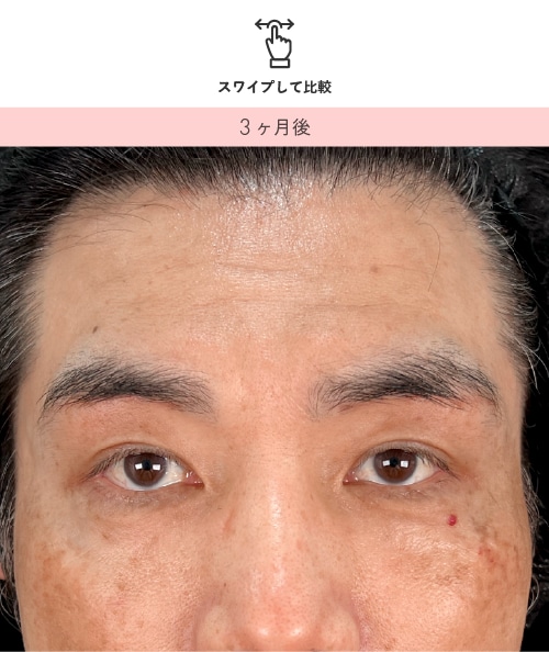 眉下リフト 術後