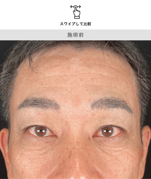 眉下リフト 術前