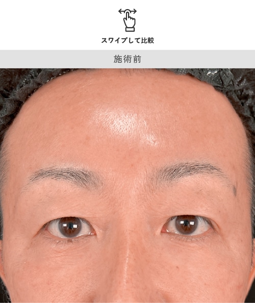 40代男性 眉下リフト 術前