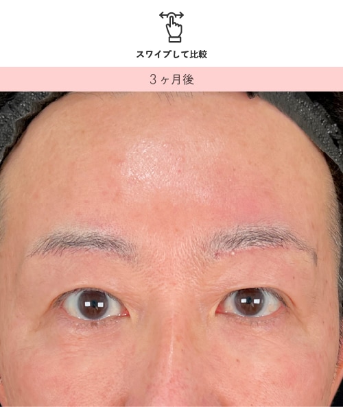 40代男性 眉下リフト 3ヶ月後