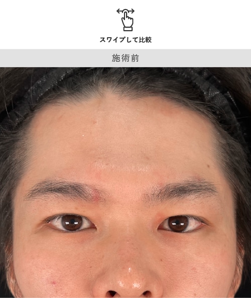 20代男性 眉下リフト 術前