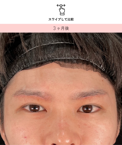 20代男性 眉下リフト 3ヶ月後