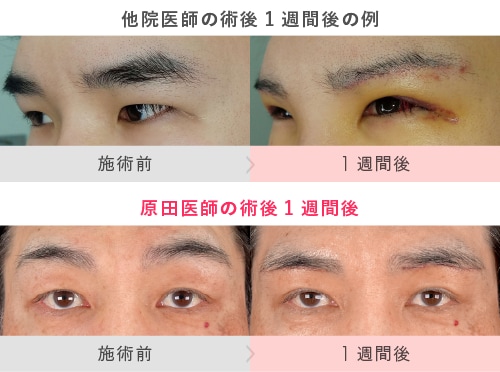 メイクで隠せないからこそ<br />
「腫れない技術」が必須