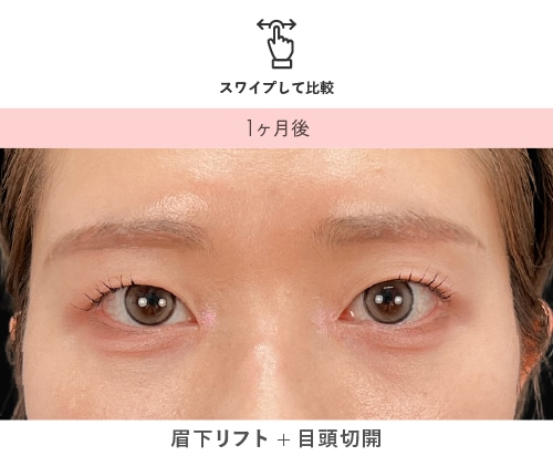 眉下リフト+目頭切開 術後1ヶ月