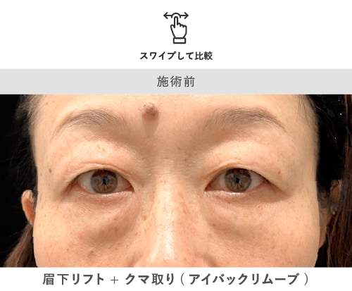 眉下リフト+クマ取り 術前