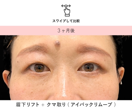 眉下リフト+クマ取り 術後3ヶ月