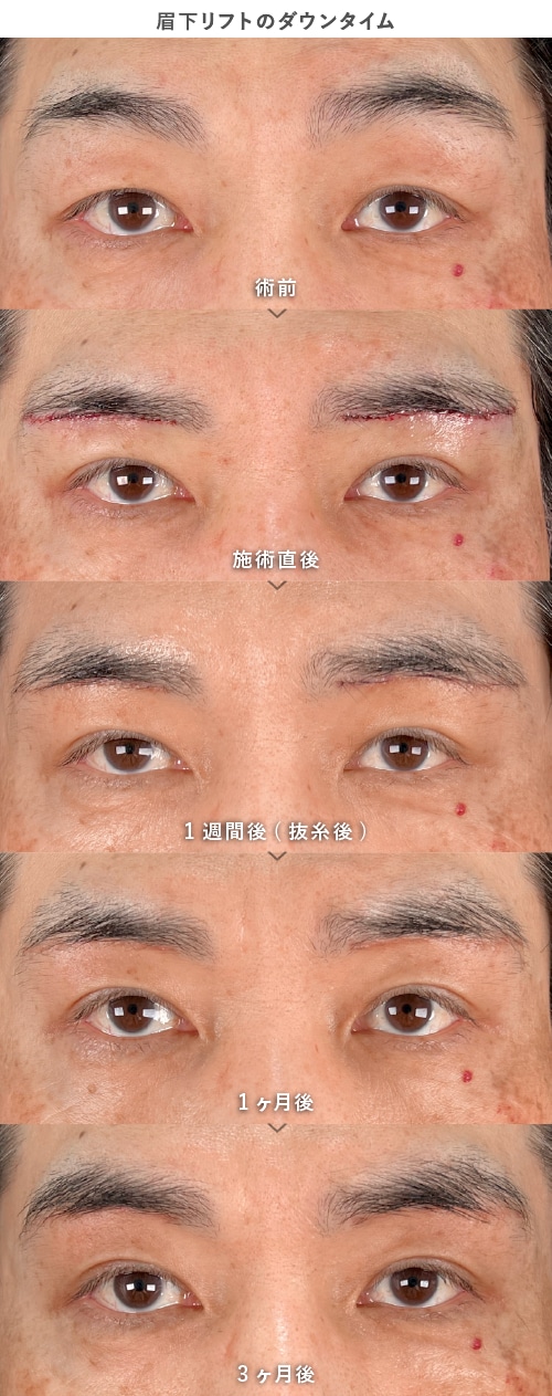 ダウンタイム・抜糸について