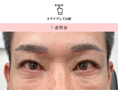 眉下リフト 術後1週間