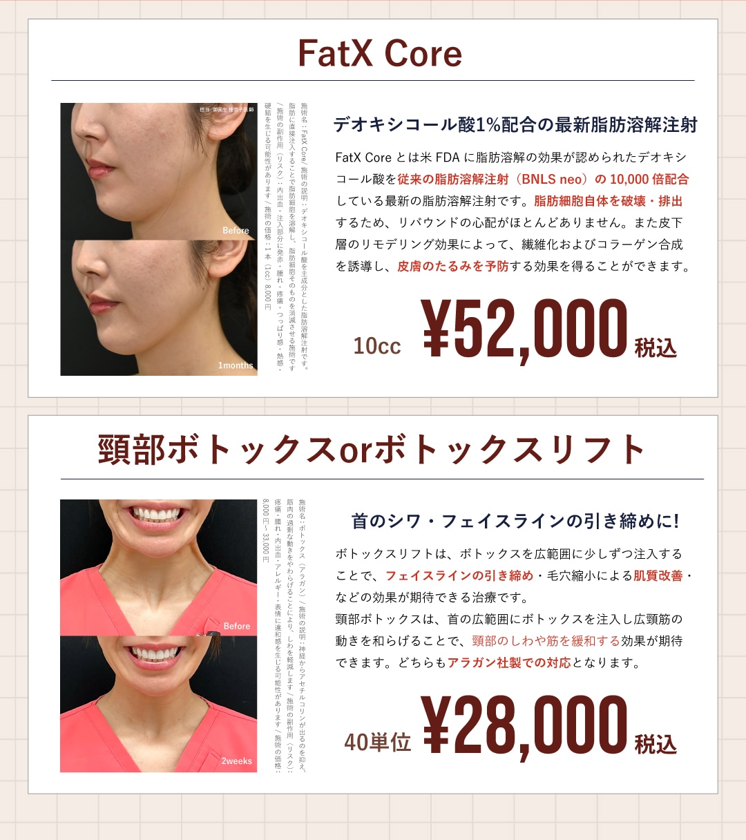 FatX core・ボトックスがお得！
