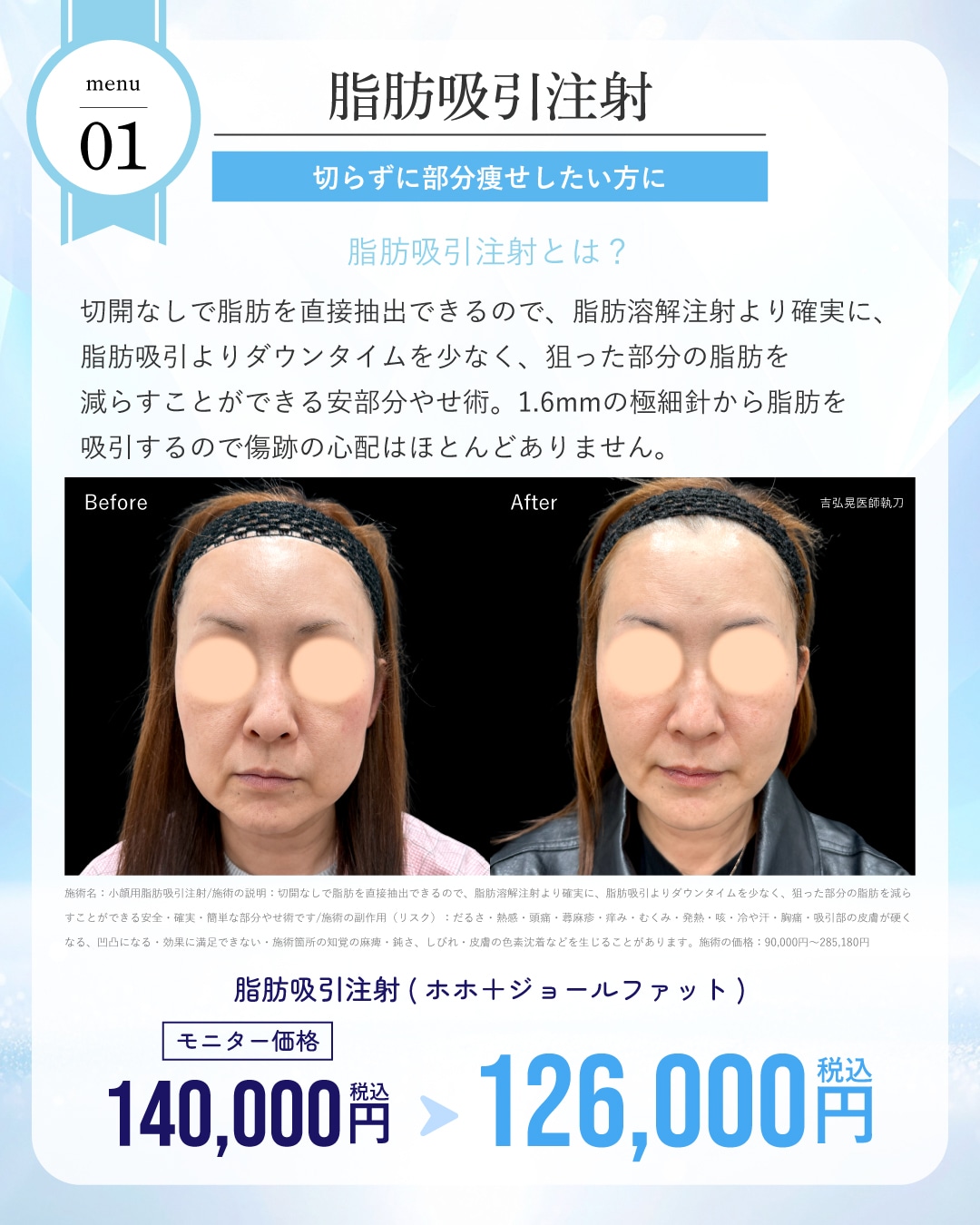 脂肪吸引注射が通常・モニター価格ともに10%OFF