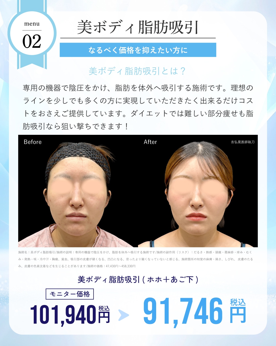 美ボディ脂肪吸引が通常・モニター価格ともに10%OFF