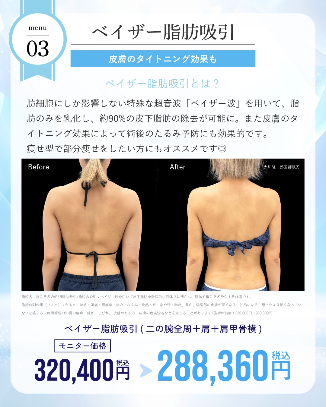 ベイザー脂肪吸引が通常・モニター価格ともに10%OFF