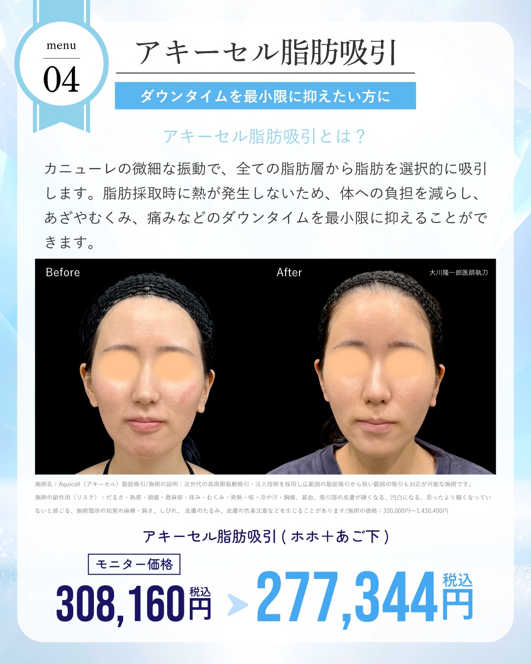 アキーセル脂肪吸引が通常・モニター価格ともに10%OFF