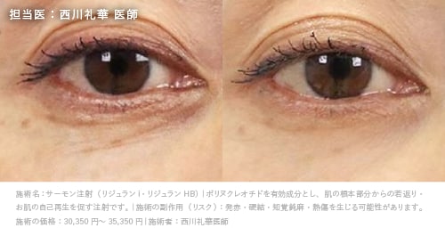 京都 リジュラン 症例写真