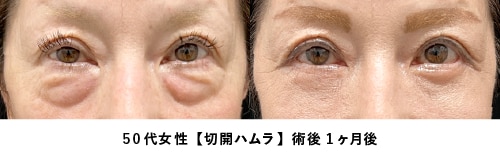 京都 クマ取り 症例写真3（50代女性・たるみ取り）