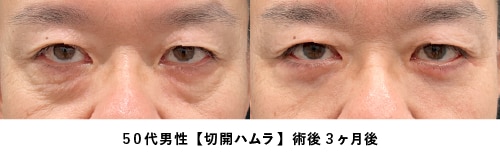 京都 クマ取り 症例写真2（50代男性・たるみ取り）