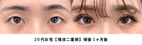 京都 二重 症例写真3（10代女性・埋没法）