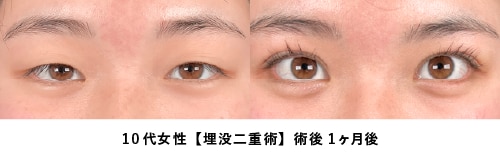 京都 二重 症例写真2（20代女性・埋没法）