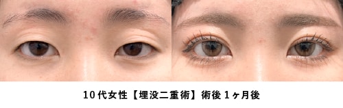 京都 二重 症例写真1（20代女性・埋没法）