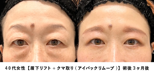 京都 眉下リフト 症例写真3（40代女性・たるみ取り）