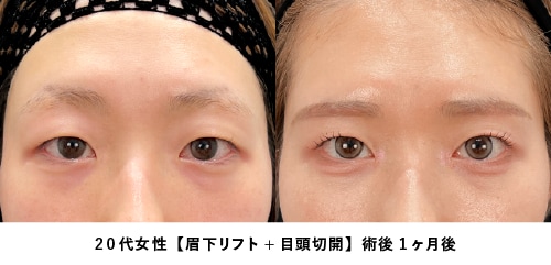 京都 眉下リフト 症例写真2（20代女性・一重のまま目を大きく）