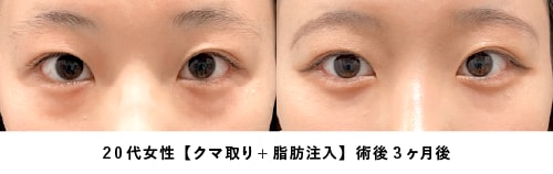 京都 クマ取り 症例写真1（20代女性・たるみ取り）