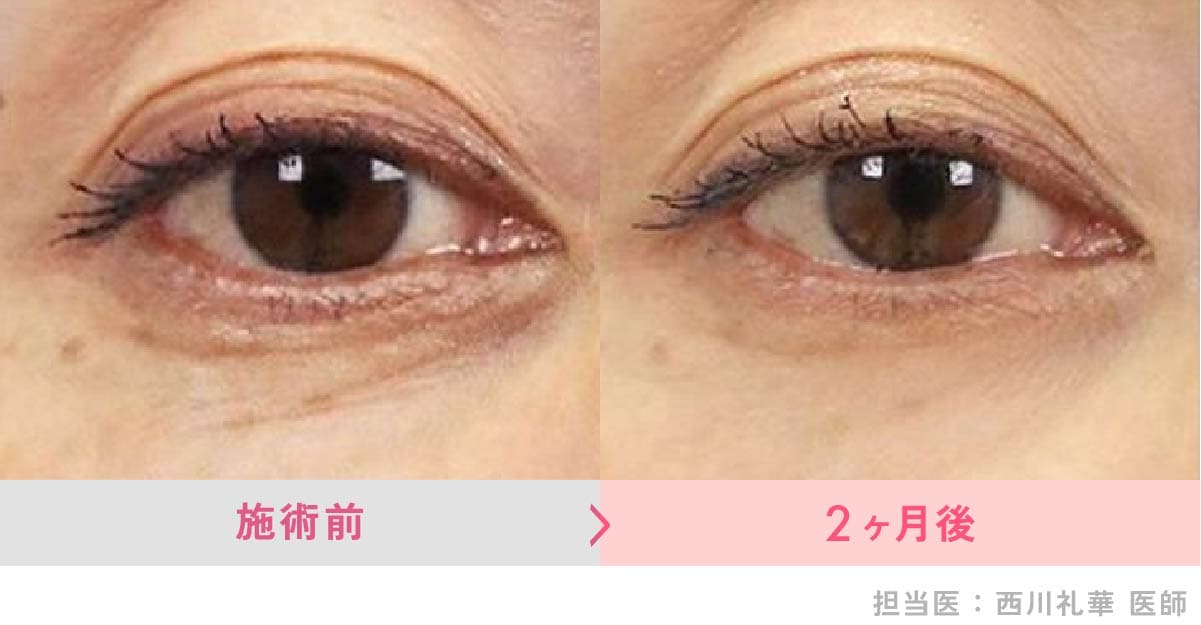 リジュラン症例写真