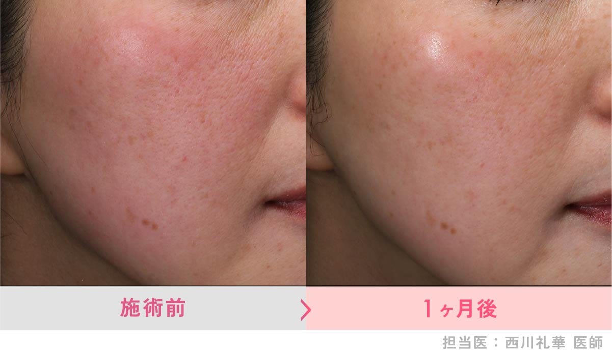 スキンバイブ症例写真1