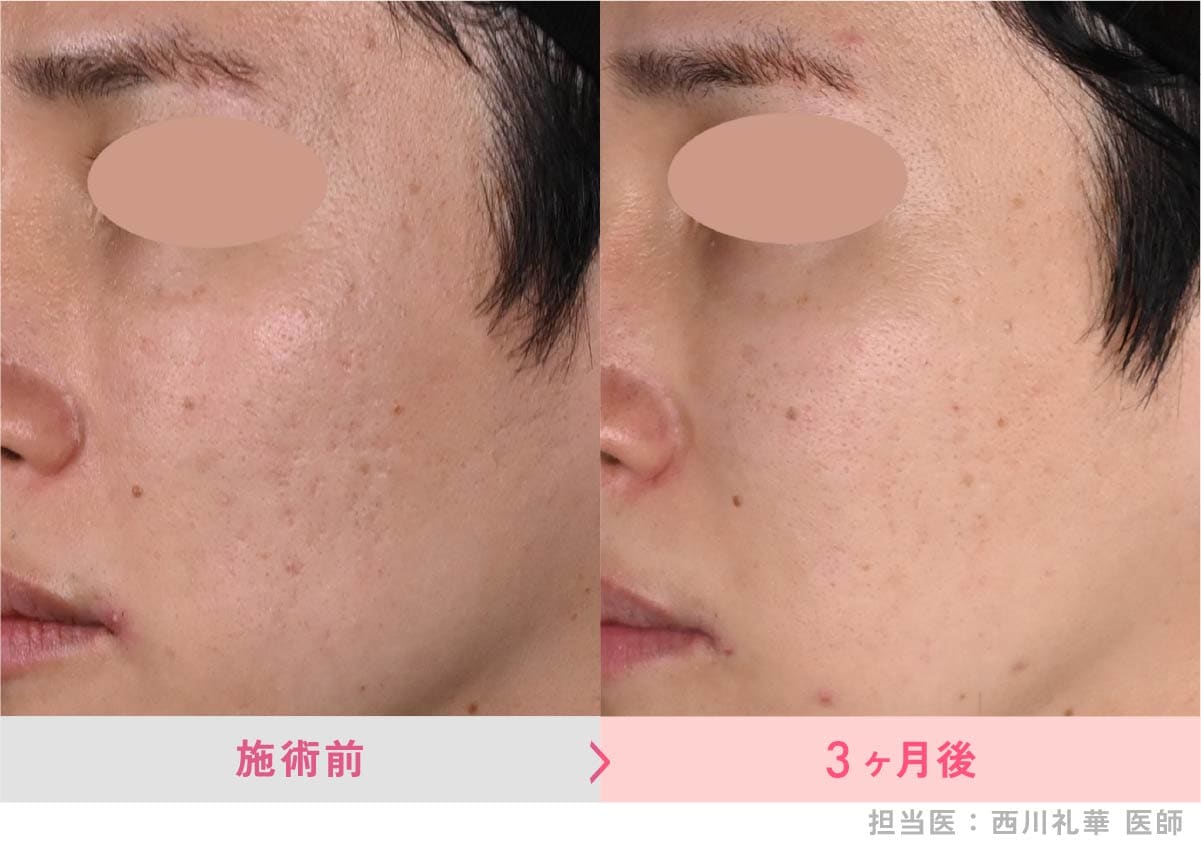 スキンバイブ症例写真2