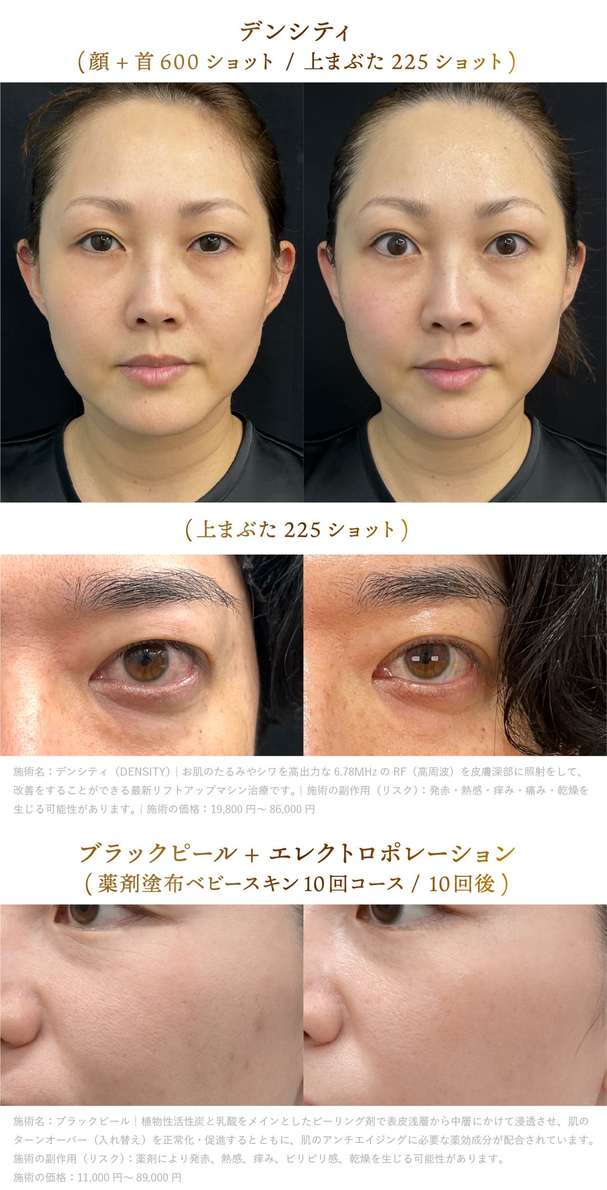 南山医師のデンシティとピーリングの美肌治療症例画像