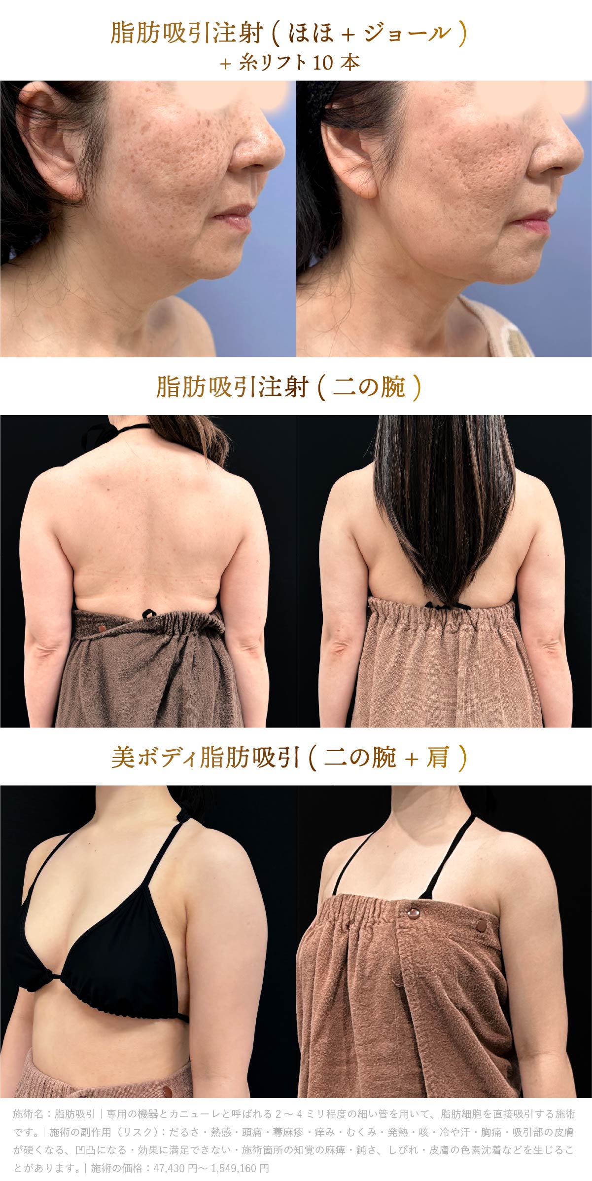 吉弘医師の脂肪吸引と糸リフト症例画像