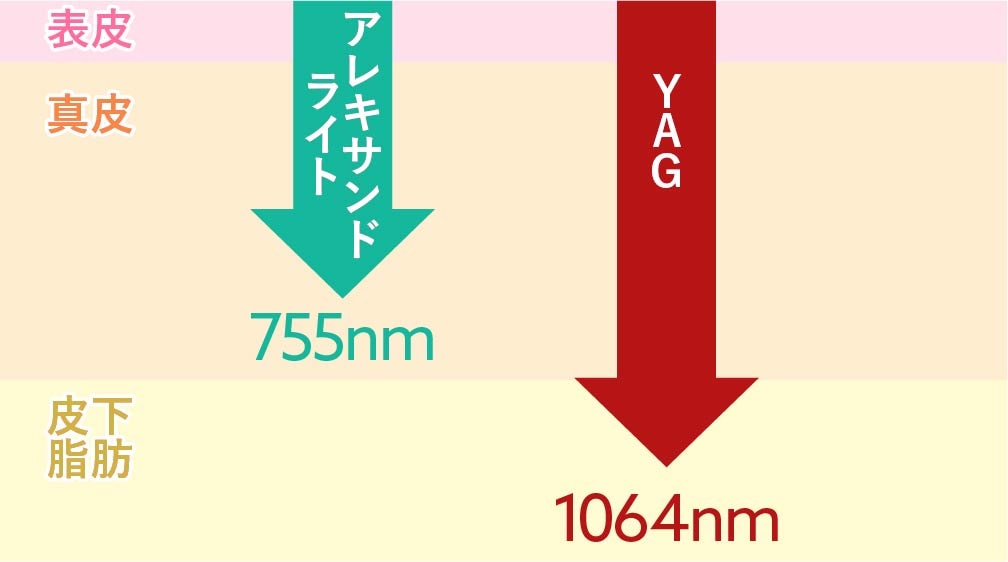 波長:アレキサンドライト / YAG